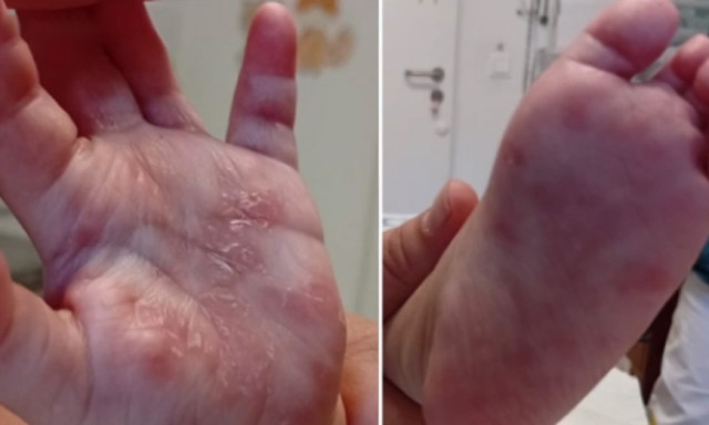 Kiskor&uacute; &eacute;s drogos anyuk&aacute;k: B&aacute;cs-Kiskunban n&eacute;gy csecsemő halt meg id&eacute;n velesz&uuml;letett szifiliszben